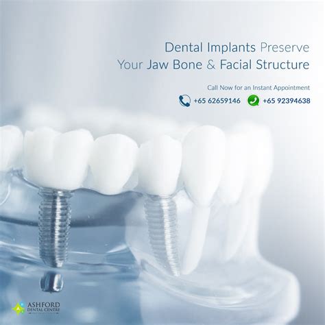 tooth implant in ashford|Teeth Implants in Ashford.